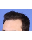 After Hair Transplant&nbsp;Front